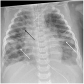 Округлые помутнения и «дерево в бутоне» – самые опасные симптомы заболеваний легких у детей при рентгене и на КТ