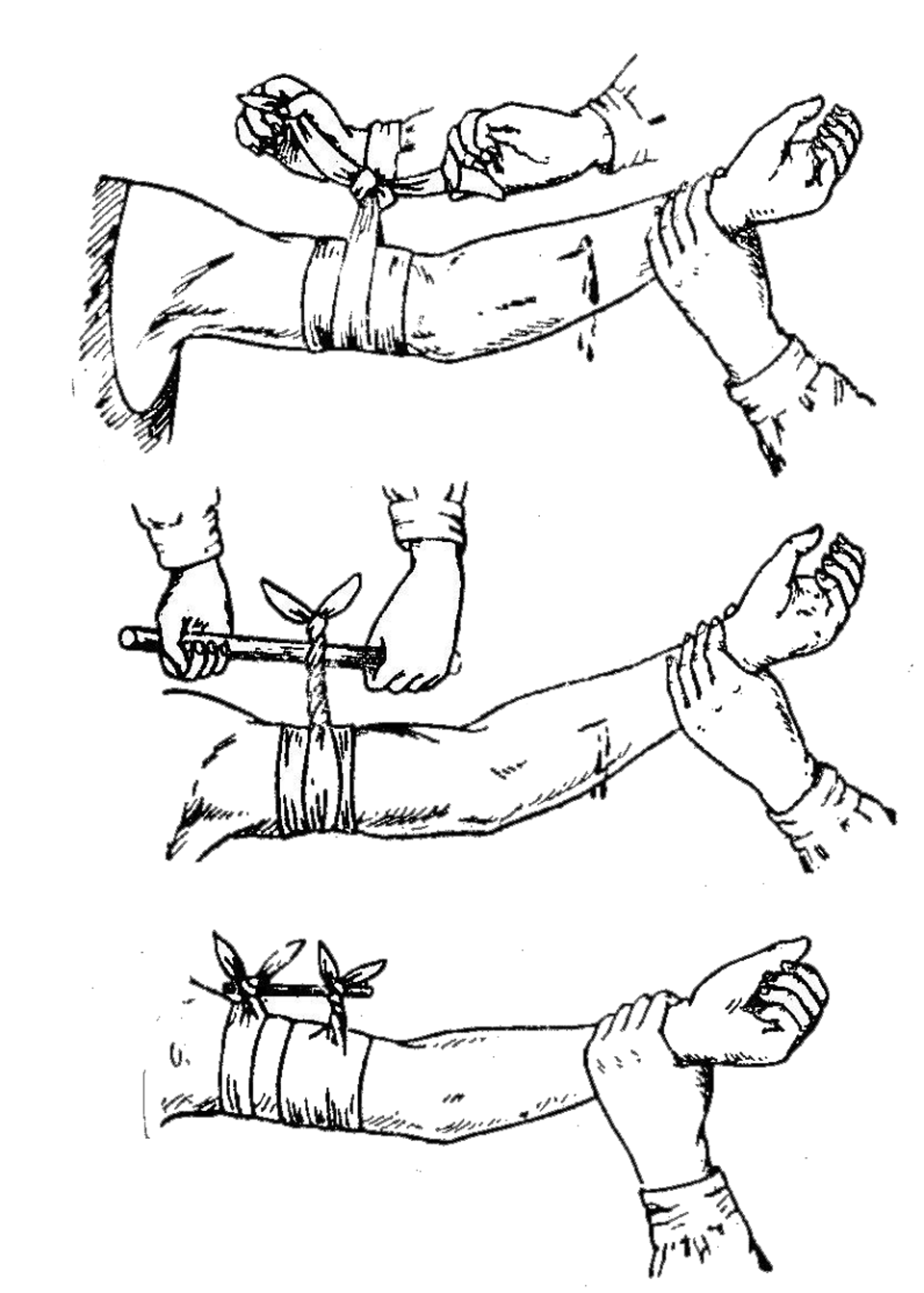 Наложение жгута на палец. Накладывание жгута при кровотечении. Закрутка способ остановки кровотечения. Способы наложения жгута для остановки кровотечения. Остановка кровотечения методом наложения жгута.