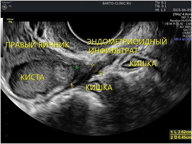 Узи эндометриоз матки фото