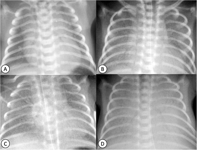 Округлые помутнения и «дерево в бутоне» – самые опасные симптомы заболеваний легких у детей при рентгене и на КТ