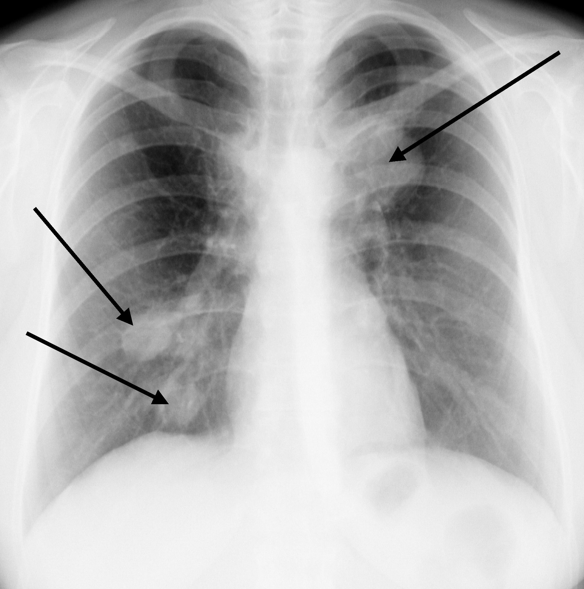 Метастазы в лёгких снимок рентген. Метастащв лёгких на рентгене. Метастазы в легкие на рентгенограмме. Признаки метастаз в легких
