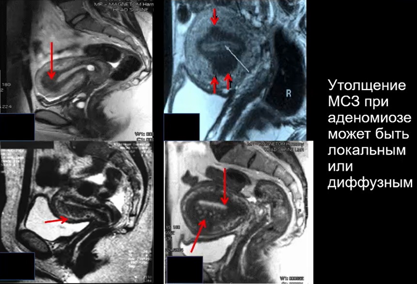 Аденомиоз на узи что это простыми словами. Аденомиоз и эндометриоз в чем разница.
