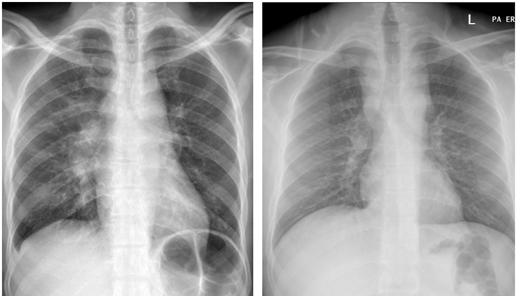 Рентгенография легочного туберкулеза. Метод, который никогда не устареет
