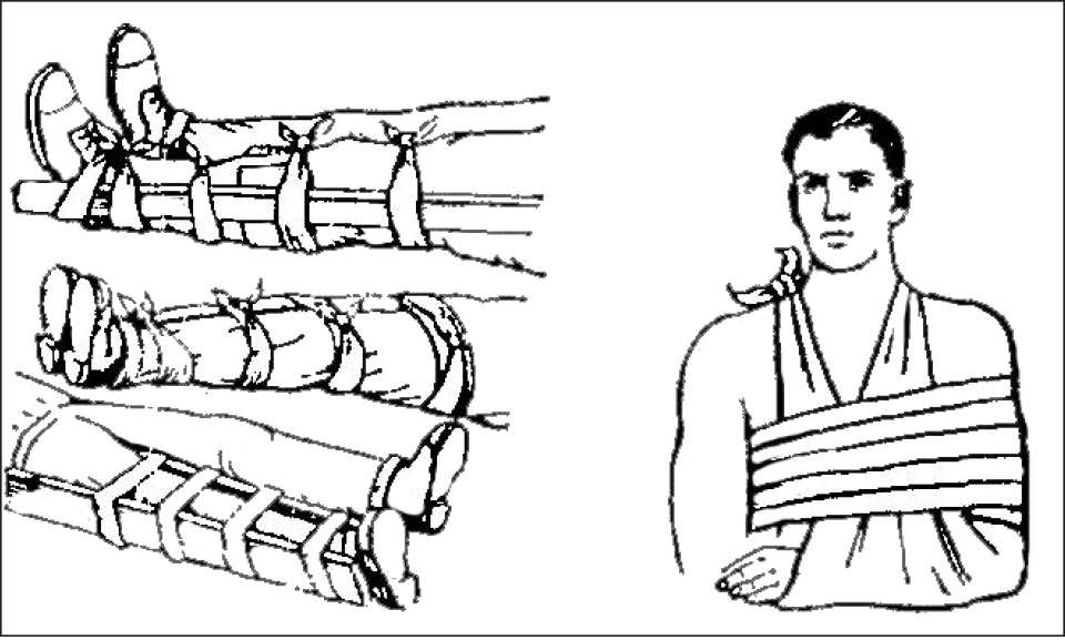 Иммобилизация при травмах конечностей. Перелом позвоночника транспортная иммобилизация. Иммобилизация при травмах конечностей. Транспортная иммобилизация при переломе большеберцовой кости. Транспортная иммобилизация при переломах.